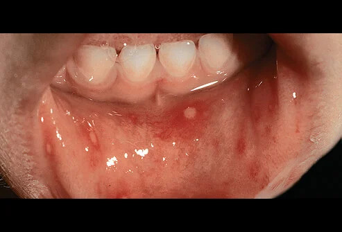 Sumber: Fitzpatrick's Color Atlas & Synopsis of Clinical Dermatology Klaus Wolff, Richard Allen Johnson, Dick Suurmond Copyright 2005, 2001, 1997, 1993 by The McGraw-Hill Companies. All Rights reserved.